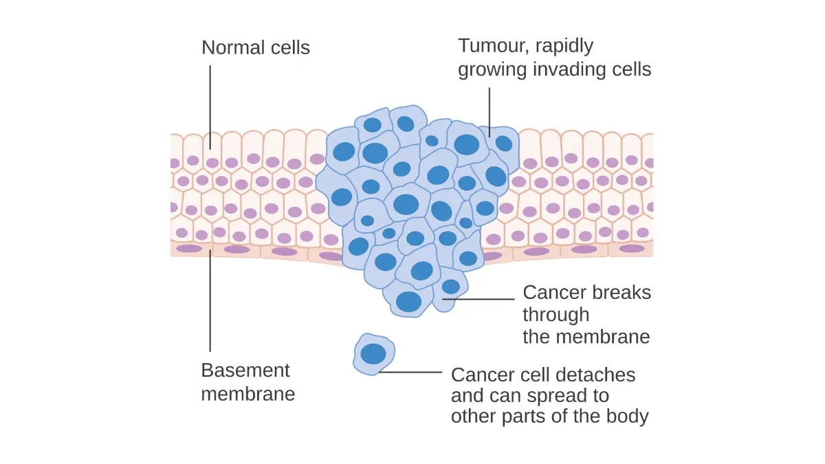 CRUK medical diagram showing a malignant tumor invading surrounding airway tissue — illustrates how lung cancer tumors block airways and produce persistent cough as a sign of lung cancer
