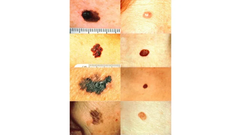 ABCDE melanoma warning signs showing normal moles vs melanoma lesions — best sunscreen for melanoma prevention starts with knowing the warning signs