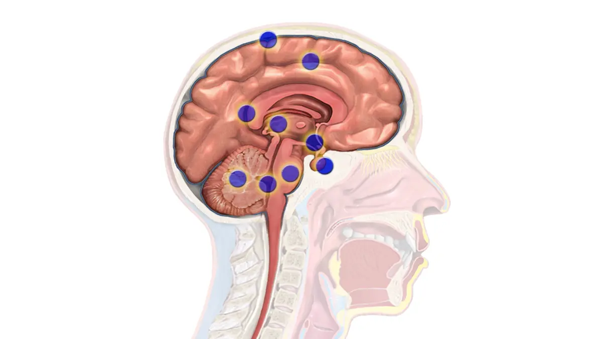 Brain anatomy diagram showing regions affected by melanoma brain metastases causing neurological symptoms including seizures headaches and vision loss
