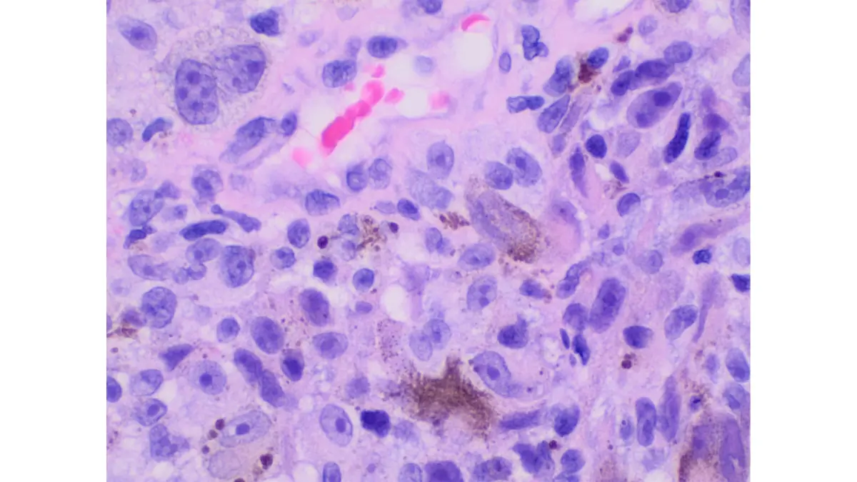 High magnification histopathology of invasive melanoma cells determining treatment selection and prognosis for melanoma brain metastases patients