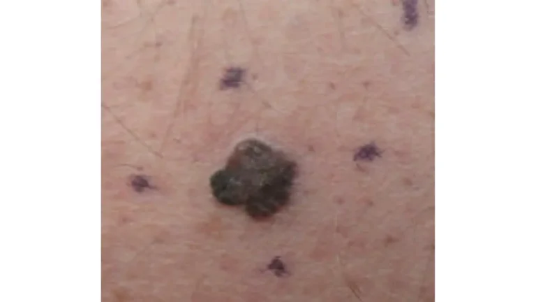 Melanoma dark skin — clinical photograph showing irregular dark pigmented malignant melanoma lesion on the thigh