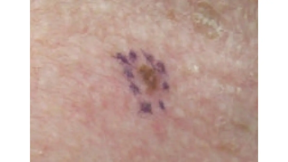 Melanoma dark skin — evolving malignant melanoma in situ on right clavicle demonstrating the E for Evolving criterion in the modified ABCDE detection system