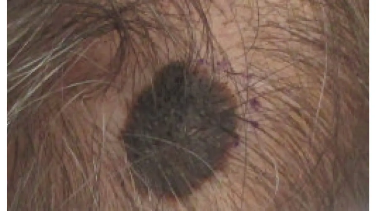 Melanoma dark skin — malignant melanoma on the mid-frontal scalp showing a hidden location frequently missed in routine medical examinations