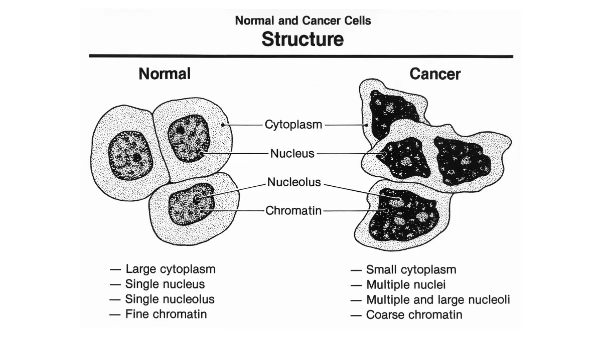 NCI medical illustration comparing normal cells and cancer cells structure showing irregular nucleus and uncontrolled division in melanoma diet context for skin cancer patients
