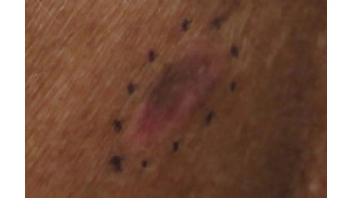 Melanoma during pregnancy — malignant melanoma on the back showing ABCDE warning signs asymmetry border color diameter
