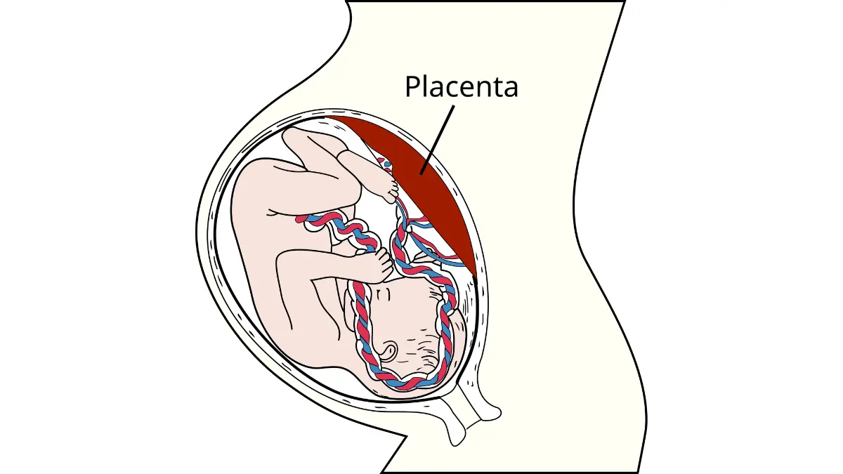 Melanoma during pregnancy — post-excision surgical site after wide local excision showing treatment is safe in all trimesters