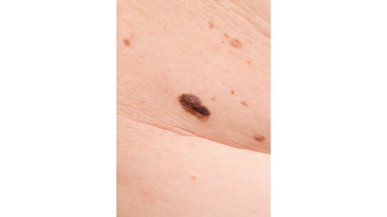 Melanoma during pregnancy — cutaneous melanoma skin cancer lesion on adult woman showing warning signs