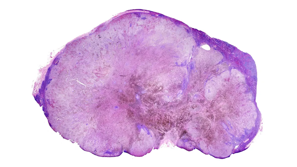 Lymph node with metastatic melanoma showing melanoma brain metastases spread pathway through bloodstream and lymphatic system
