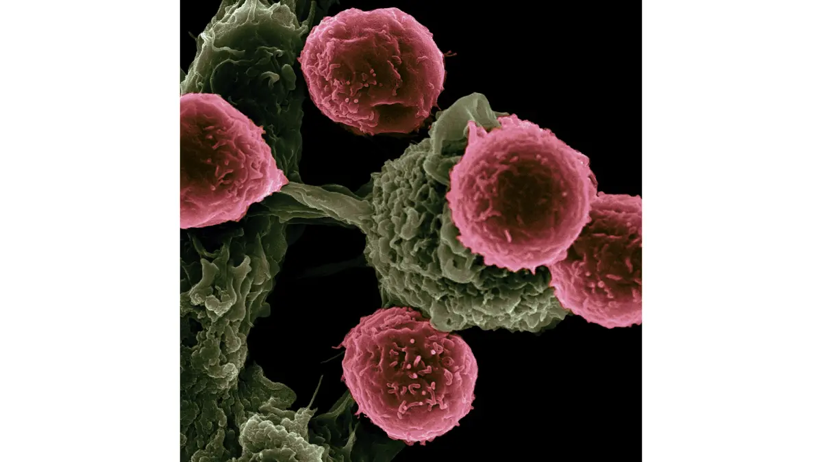 Electron microscope image of dendritic cells (green) interacting with T cells (pink) in nanoparticle cancer vaccine research — the science behind KEYNOTE-942 Phase 3 melanoma clinical trial recruiting in 2026