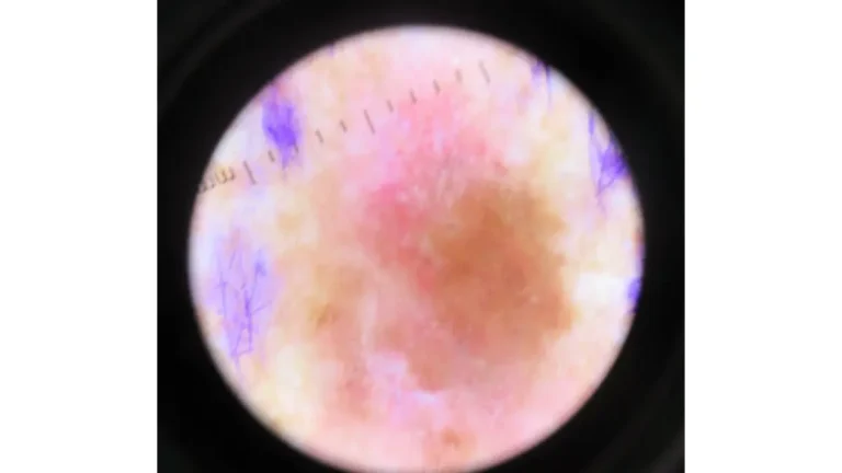 Dermoscopy clinical image of malignant melanoma on the upper back showing irregular pigmentation and border changes — key warning signs of melanoma recurrence detected during dermatologist follow-up