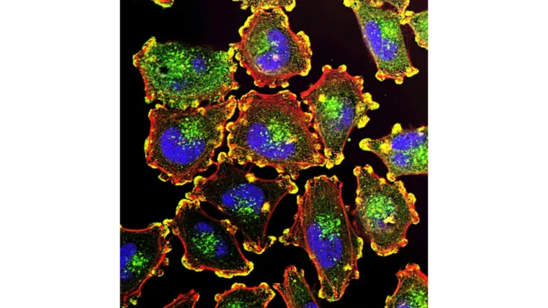 Metastatic melanoma cells under fluorescence microscopy showing podosomes in yellow — the cancer biology targeted by melanoma clinical trials in 2026