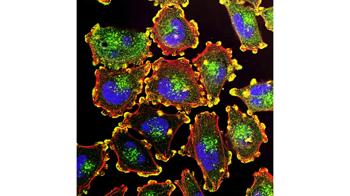 Metastatic melanoma cells under fluorescence microscopy showing podosomes in yellow — the cancer biology targeted by melanoma clinical trials in 2026