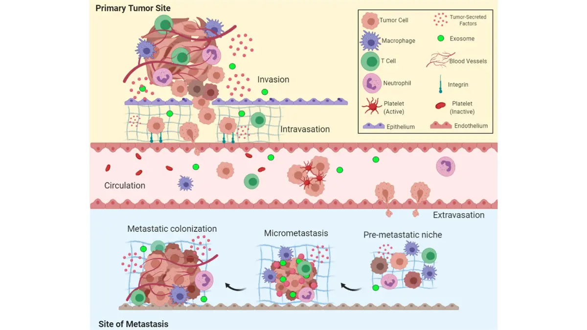 Stage 4 melanoma metastatic spread process diagram showing five steps of how melanoma tumor cells invade local tissue enter bloodstream circulate to distant organs exit blood vessels and colonize new metastatic sites