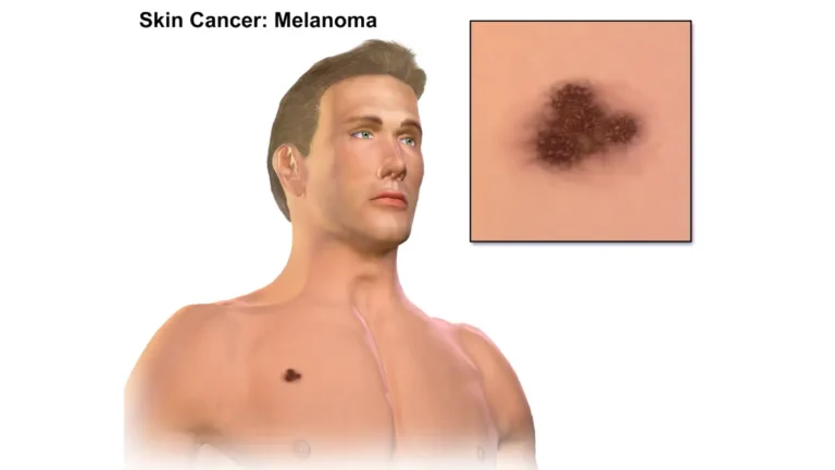 Mohs surgery for melanoma — medical vector illustration showing melanoma skin cancer anatomy and melanocyte cells in the basal layer