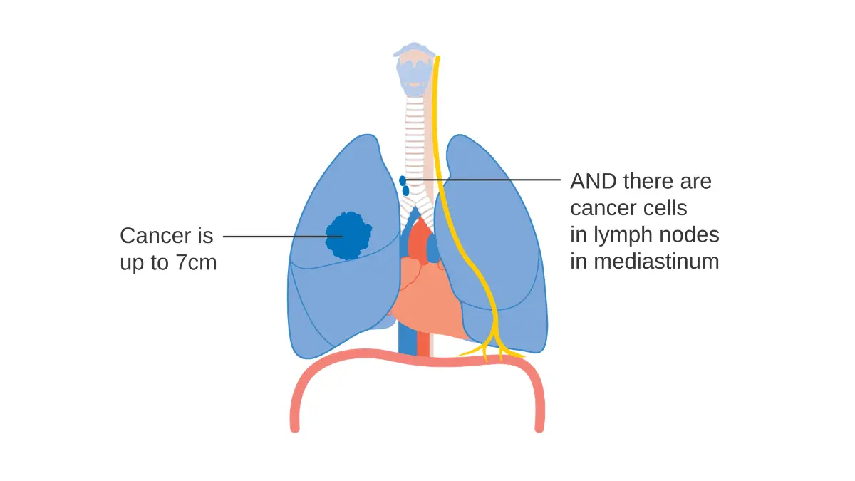 CRUK medical diagram showing stage 3A non-small cell lung cancer tumor position in chest with bronchial tree and lymph node spread — non-small cell vs small cell lung cancer staging guide