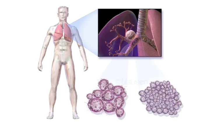 3D medical illustration of non-small cell vs small cell lung cancer tumor growing inside human lung tissue showing bronchial airways