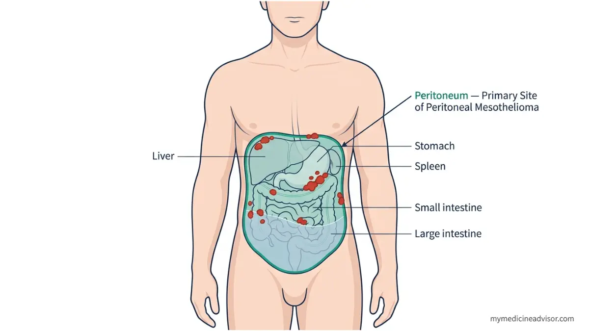 Peritoneal Mesothelioma anatomy diagram showing peritoneal lining tumor nodules and ascites in abdominal cavity