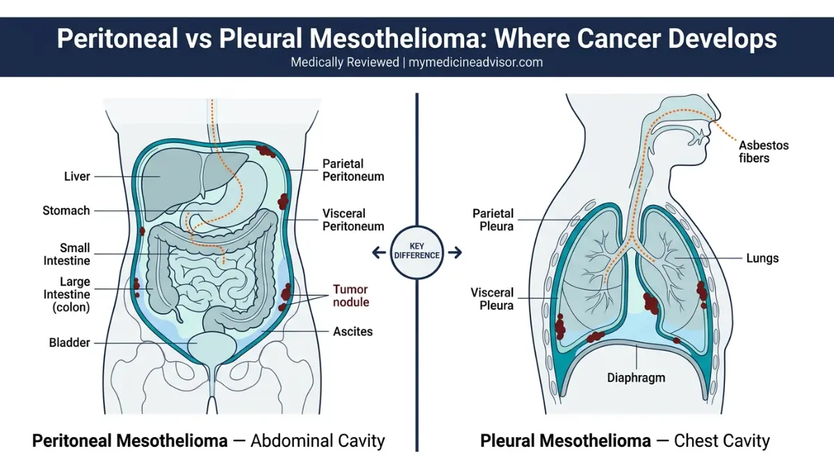 Peritoneal Mesothelioma vs pleural mesothelioma anatomy comparison showing abdominal cavity peritoneum and lung pleura tumor locations