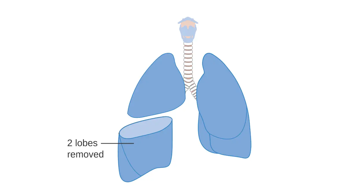 Rare types of lung cancer treatment — medical diagram showing bilobectomy surgical removal of two lung lobes used in treating Pancoast tumors and lung carcinoid rare lung cancer types