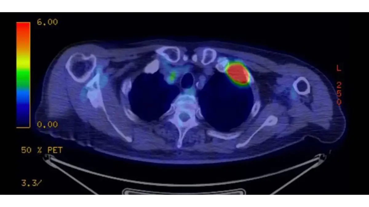 Rare types of lung cancer — PET scan showing an anterior Pancoast tumor at the apex of the lung causing shoulder pain and Horner's syndrome in a rare lung cancer subtype