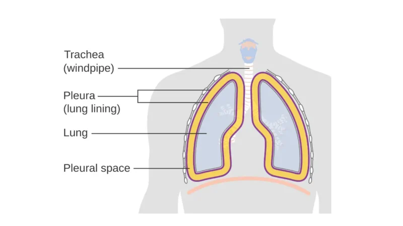 Rare types of lung cancer — anatomical diagram showing the lining of the lungs (pleura) including visceral and parietal pleural layers where rare lung cancers develop