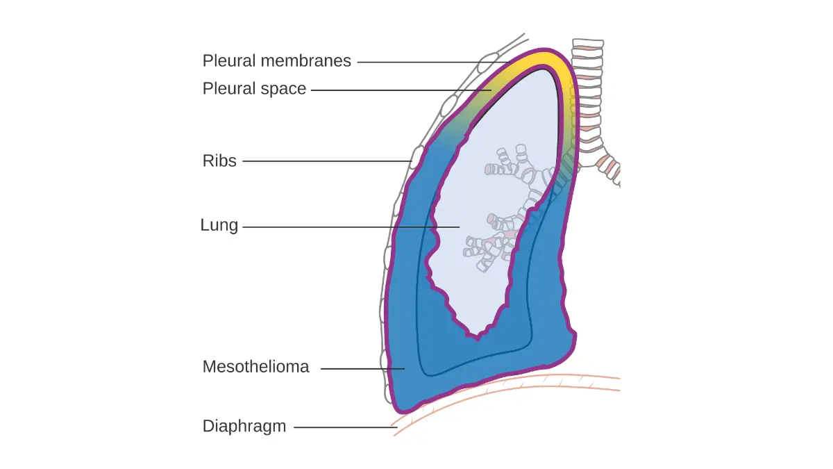 Rare types of lung cancer — clinical diagram showing pleural mesothelioma tumor growth in the lining of the lung caused by asbestos exposure in this rare lung cancer type