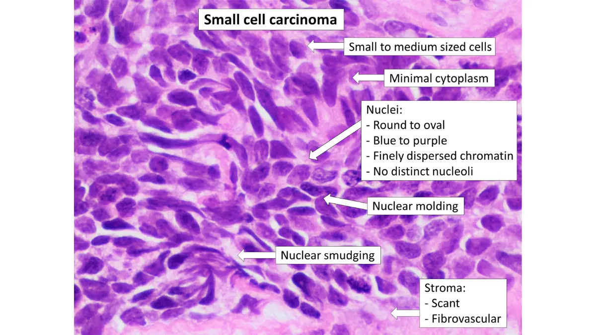 Annotated histopathology microscope slide of small cell lung carcinoma SCLC showing dense round oat cells — non-small cell vs small cell lung cancer cellular comparison