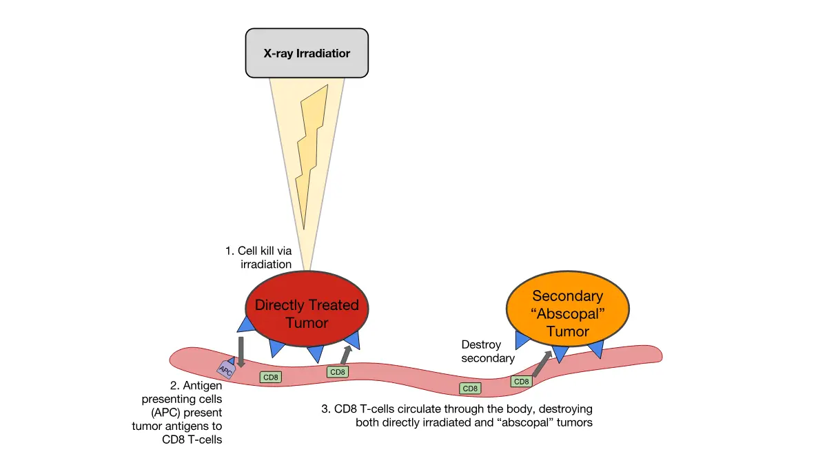 Stage 4 melanoma abscopal effect illustration showing how stereotactic radiosurgery at a primary tumor site releases cancer antigens that activate T cells to attack distant metastatic melanoma deposits throughout the body