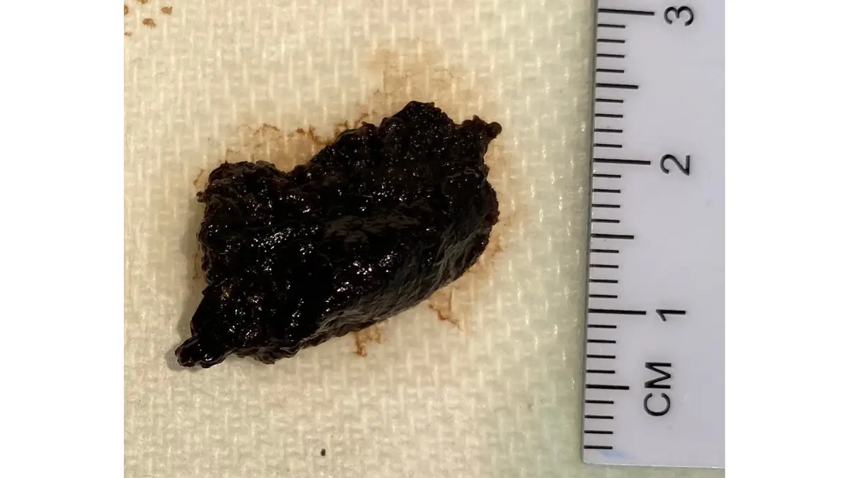 Stage 4 melanoma M1d brain metastases gross pathology specimen image showing dark pigmented melanoma tumor deposits in brain tissue representing the most advanced sub-stage with 19 to 27 percent five year survival rate treated with stereotactic radiosurgery and immunotherapy