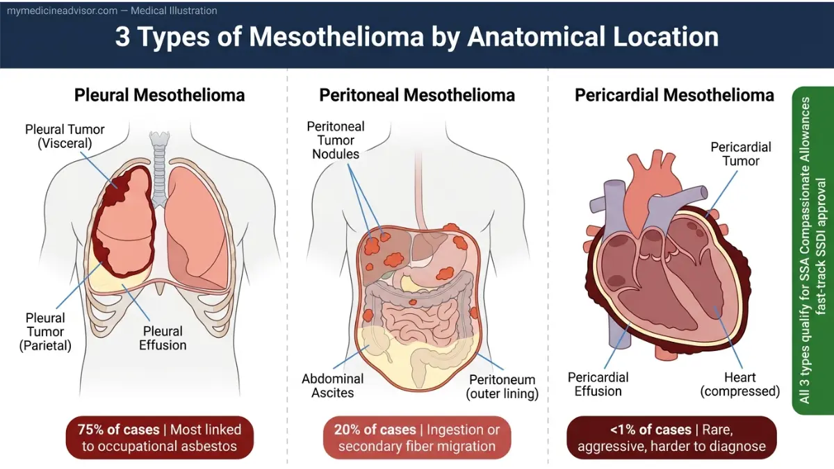 Mesothelioma Financial Aid anatomy comparison diagram showing pleural, peritoneal, and pericardial mesothelioma locations in the body