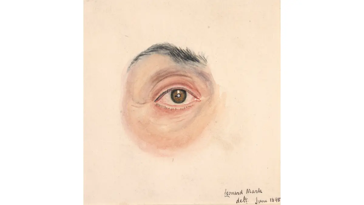 High-resolution medical documentation photograph of iris melanoma from the Wellcome Collection, used in uveal melanoma clinical diagnosis and ophthalmic oncology