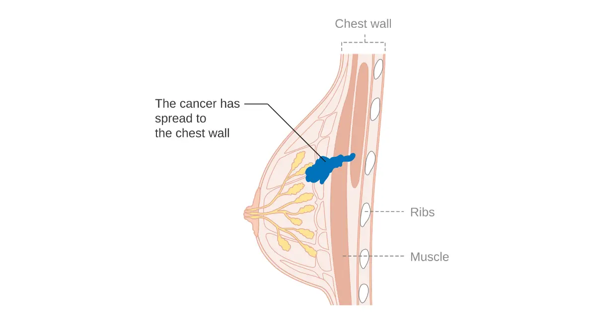 Black Women breast cancer stage 3B illustration showing advanced-stage disease linked to delayed diagnosis and referral.
