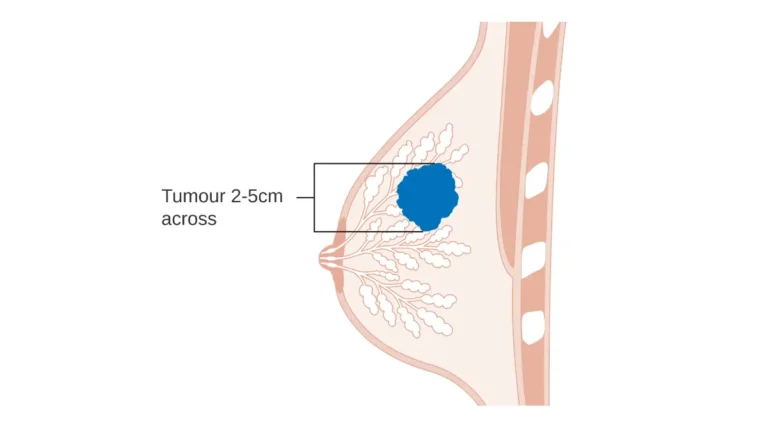 Black Women breast cancer stage T2 illustration showing tumor size classification and early diagnosis context.