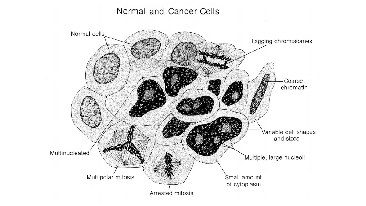 Black Women normal and cancer cells labeled illustration explaining how abnormal breast cells differ from healthy cells.