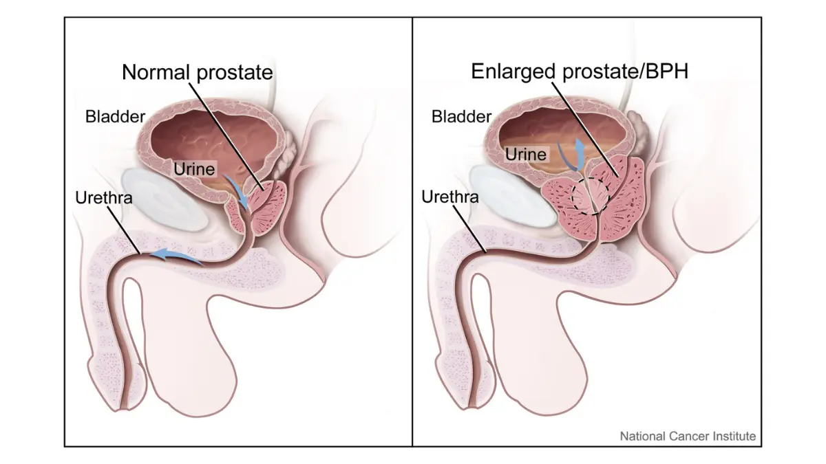 Two-panel medical illustration comparing normal prostate anatomy with enlarged prostate BPH urinary flow, showing why early signs of urinary symptoms are more often caused by benign enlargement than by prostate cancer.