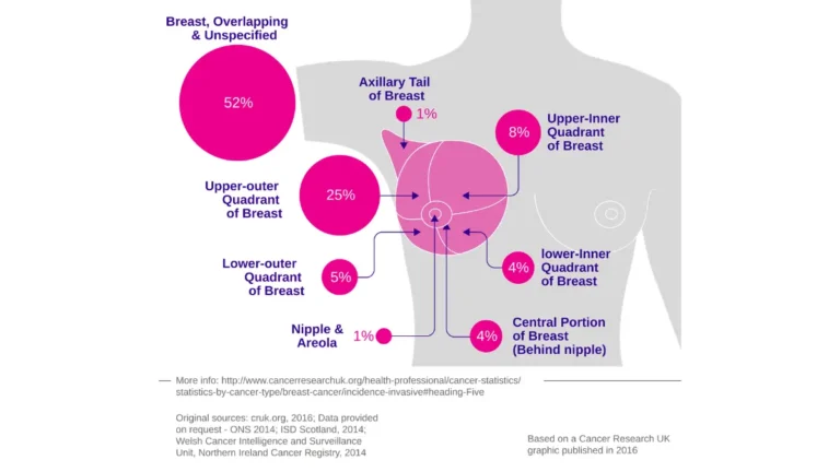 Breast cancer in Black women — anatomical incidence diagram showing breast cancer distribution by site in female breast tissue.