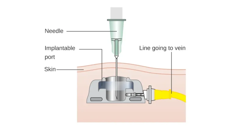 Implantable port under the skin diagram used for IV access during breast cancer chemotherapy infusion.