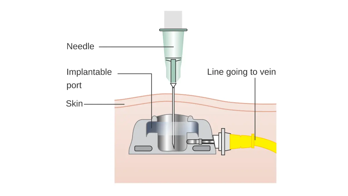 Implantable port under the skin diagram used for IV access during breast cancer chemotherapy infusion.