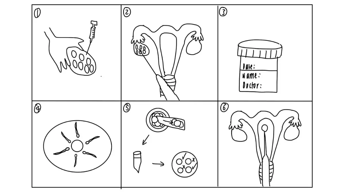 Breast cancer fertility preservation diagram showing IVF steps, including ovarian stimulation, egg retrieval, fertilization, and embryo transfer.