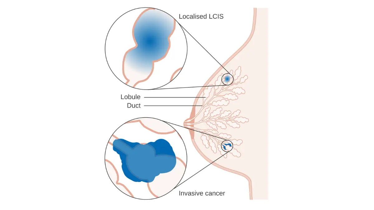 breast cancer questions pathology illustration showing lobular carcinoma in situ within breast tissue to support understanding of pathology report findings.
