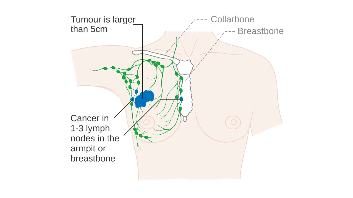 breast cancer questions advanced-stage breast cancer anatomy illustration showing Stage 3A disease for second-opinion and multidisciplinary review context.