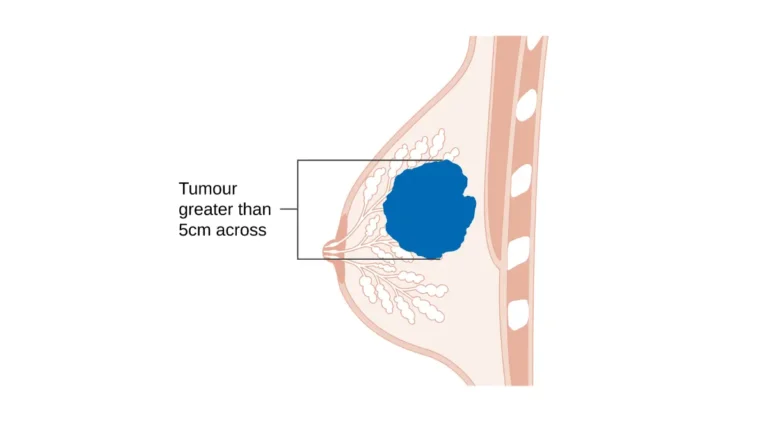 breast cancer questions anatomy illustration showing a Stage T3 breast tumor inside the breast to support diagnosis and treatment planning.