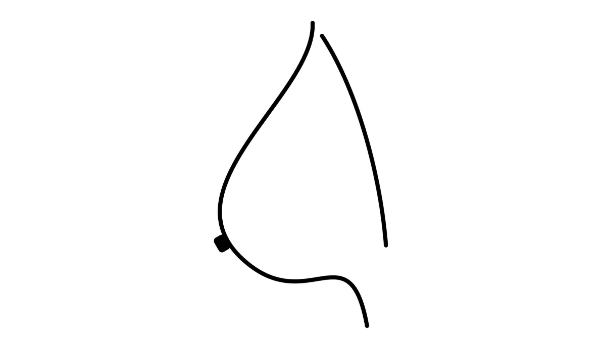 Breast cancer radiation target area shown on a lateral female breast anatomy diagram.