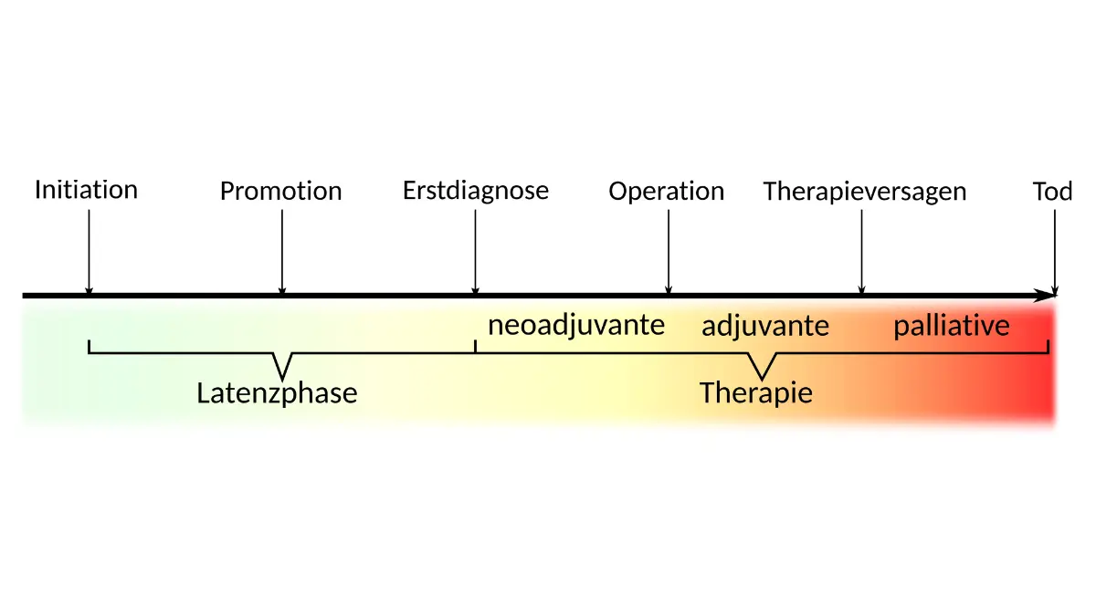 Breast cancer radiation shown within a cancer development and therapy diagram illustrating how treatment changes tumor progression.