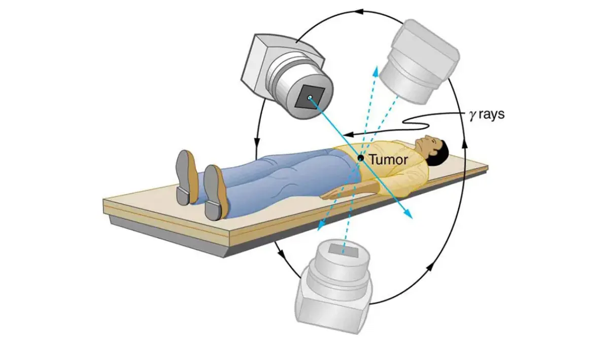 Breast cancer radiation external beam therapy diagram showing multiple radiation beams intersecting at a tumor.