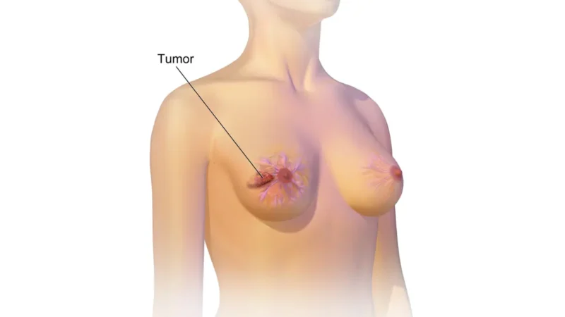 Breast cancer radiation concept showing a highlighted breast tumor on the left breast.