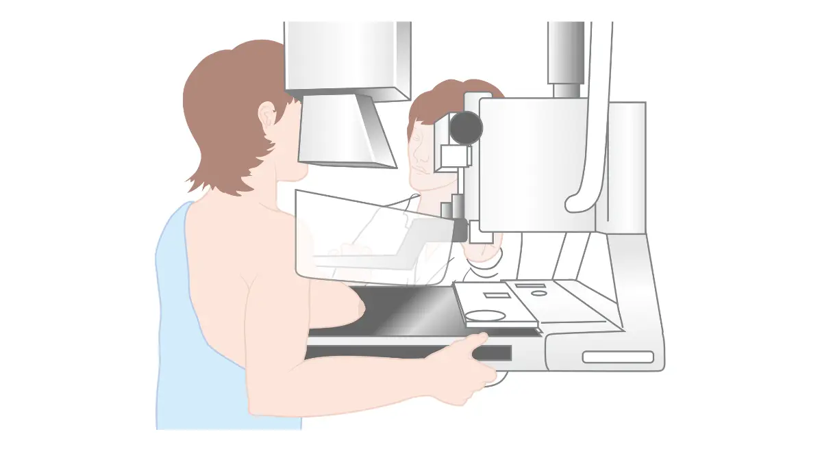 breast cancer screening diagram showing a woman having a mammogram at an imaging machine