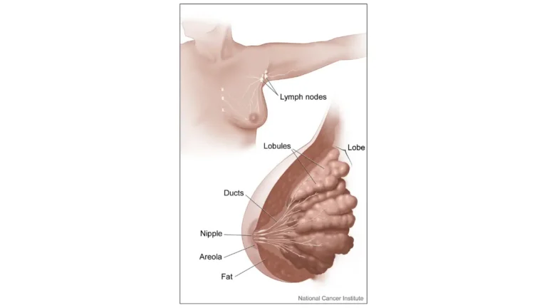 Breast Cancer Stages illustration showing breast anatomy and adjacent lymph nodes