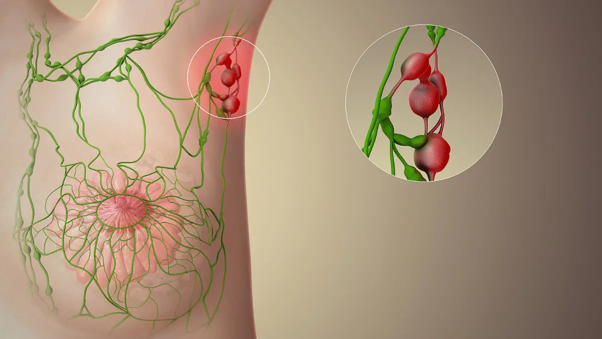 Breast Cancer Stages diagram showing lymph node network around the breast and axillary region