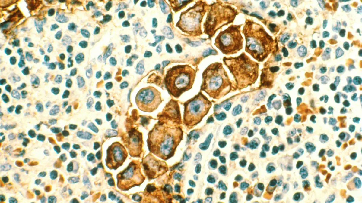 Breast Cancer Stages image showing breast lymph nodes and regional lymphatic spread pathways